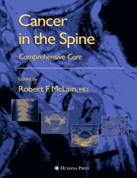 Cover image: Cancer in the Spine 1st edition 9781588290748