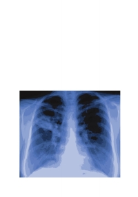 Cover image: Bronchial Asthma 5th edition 9781588296047