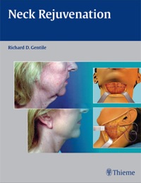 Cover image: Neck Rejuvenation 1st edition 9781604060560