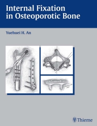 Immagine di copertina: Internal Fixation in Osteoporotic Bone 1st edition 9781588900876