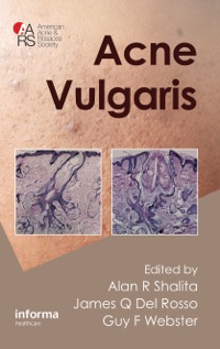 Cover image: Acne Vulgaris 1st edition 9781841847078