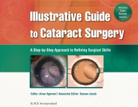 Cover image: Illustrative Guide to Cataract Surgery 9781556429811