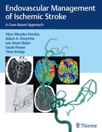 Cover image: Endovascular Management of Ischemic Stroke 1st edition 9781626232754