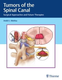 صورة الغلاف: Tumors of the Spinal Canal 1st edition 9781626239319