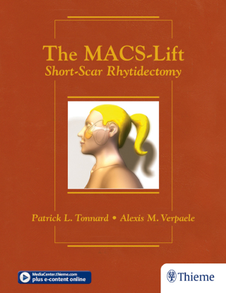 Cover image: The MACS-Lift 1st edition 9781626236332