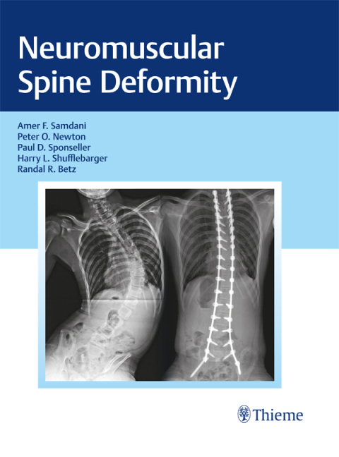 Neuromuscular Spine Deformity, 1st Edition - FULL INSTANT DOWNLOAD | PDF DOCX EPUB