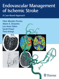 Cover image: Endovascular Management of Ischemic Stroke 1st edition 9781626232754