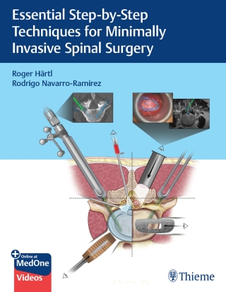 Imagen de portada: Essential Step-by-Step Techniques for Minimally Invasive Spinal Surgery 1st edition 9781684200092