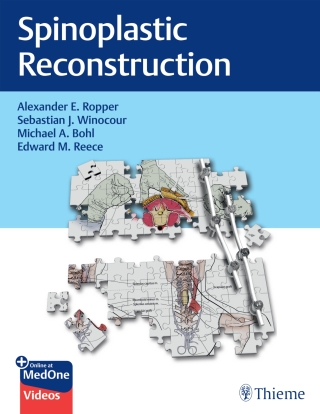 Cover image: Spinoplastic Reconstruction 1st edition 9781684205011