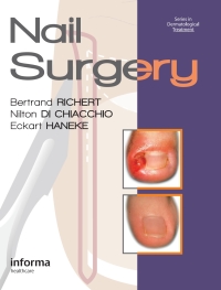 Cover image: Nail Surgery 1st edition 9780415472333