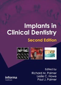 صورة الغلاف: Implants in Clinical Dentistry 2nd edition 9781841849065