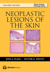 صورة الغلاف: Neoplastic Lesions of the Skin 1st edition 9781933864860