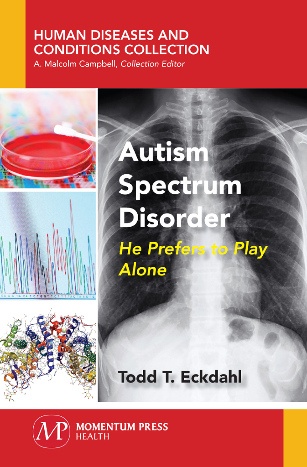 Autism Spectrum Disorder He Prefers to Play Alone