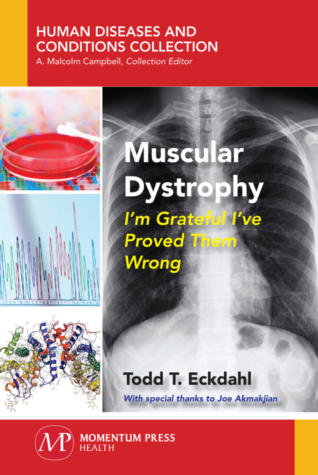 Muscular Dystrophy I’m Grateful I’ve Proved Them Wrong