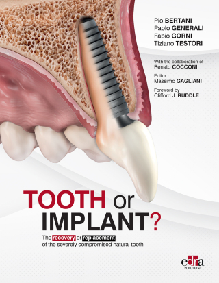 Imagen de portada: Tooth or Implant? 1st edition 9781957260525