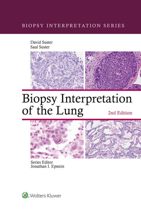Biopsy Interpretation of the Lung, 2nd Edition - FULL INSTANT DOWNLOAD | PDF DOCX EPUB