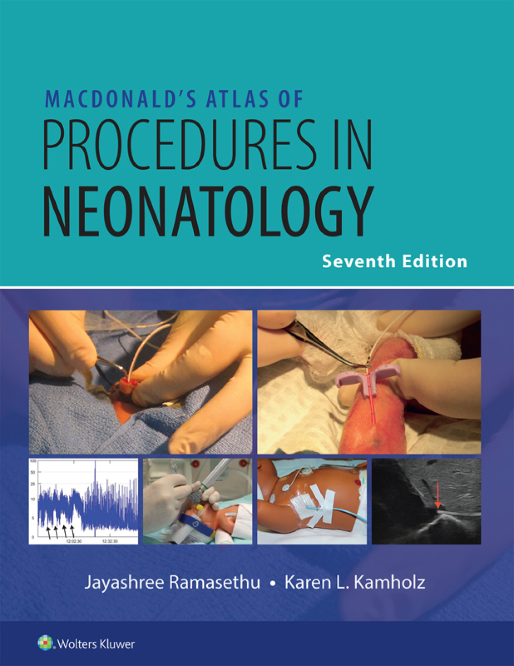 ISBN 9781975237905 product image for MacDonald’s Atlas of Procedures in Neonatology - 7th Edition (eBook) | upcitemdb.com