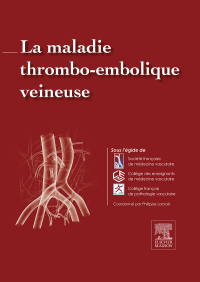 Cover image: La maladie thrombo-embolique veineuse 9782294744891