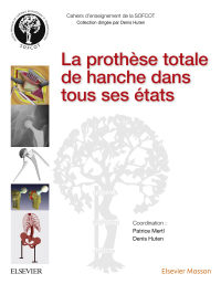 Cover image: La prothèse totale de hanche dans tous ses états 9782294751165