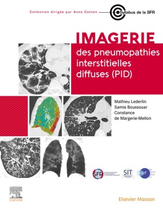 Cover image: Imagerie des pneumopathies interstitielles diffuses (PID) 1st edition 9782294781902