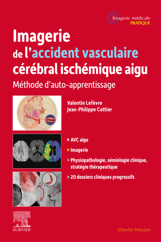 Cover image: Imagerie de l'accident vasculaire cérébral ischémique aigu 9782294788048