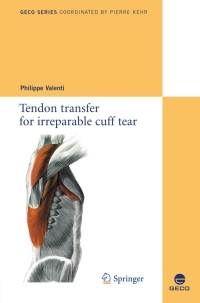 Omslagafbeelding: Tendon transfer for irreparable cuff tear 1st edition 9782817800486