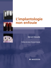Cover image: L'implantologie non enfouie 9782294704222