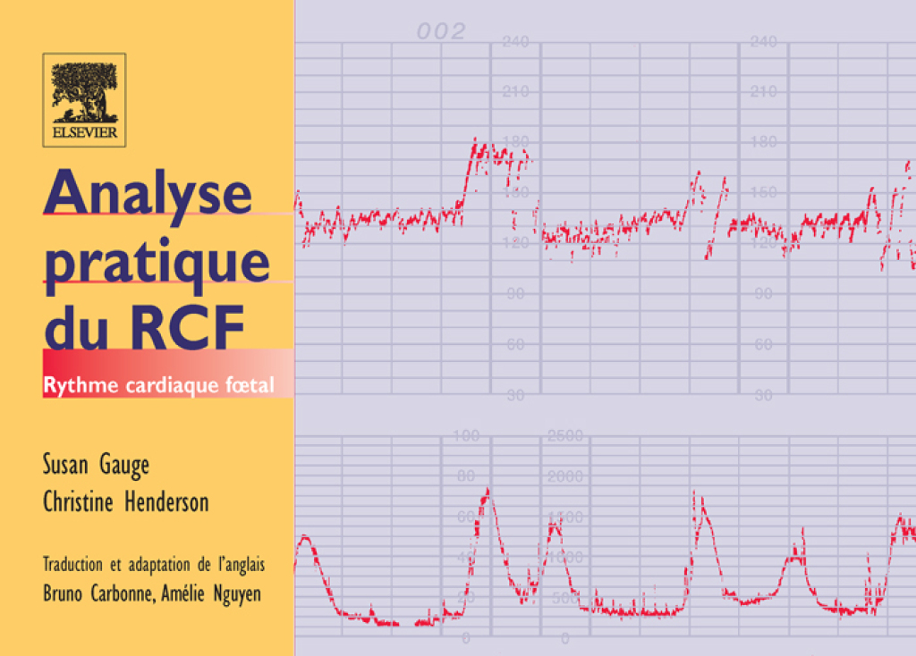 Analyse pratique du RCF Rythme cardiaque fœtal