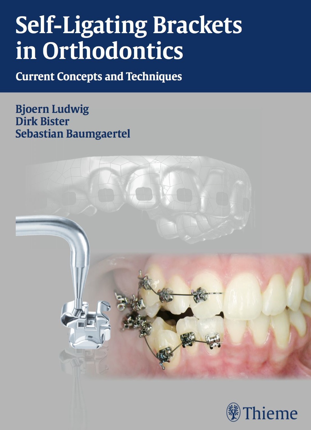 Self-Ligating Brackets in Orthodontics - 1st Edition (eBook)