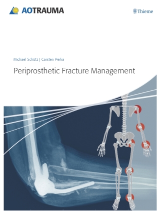صورة الغلاف: Periprosthetic Fracture Management 1st edition 9783131715111