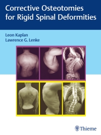 Cover image: Corrective Osteotomies for Rigid Spinal Deformities 1st edition 9783131730817