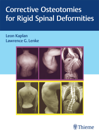 Cover image: Corrective Osteotomies for Rigid Spinal Deformities 1st edition 9783131730817