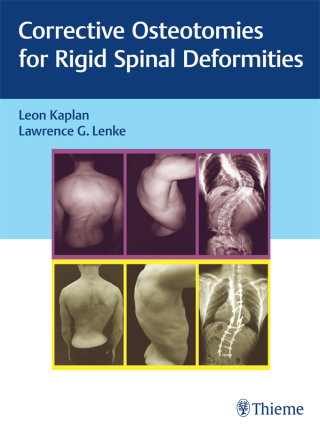 Imagen de portada: Corrective Osteotomies for Rigid Spinal Deformities 1st edition 9783131730817
