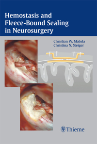 Omslagafbeelding: Hemostasis and Fleece-Bound Sealing in Neurosurgery 1st edition 9783131320414