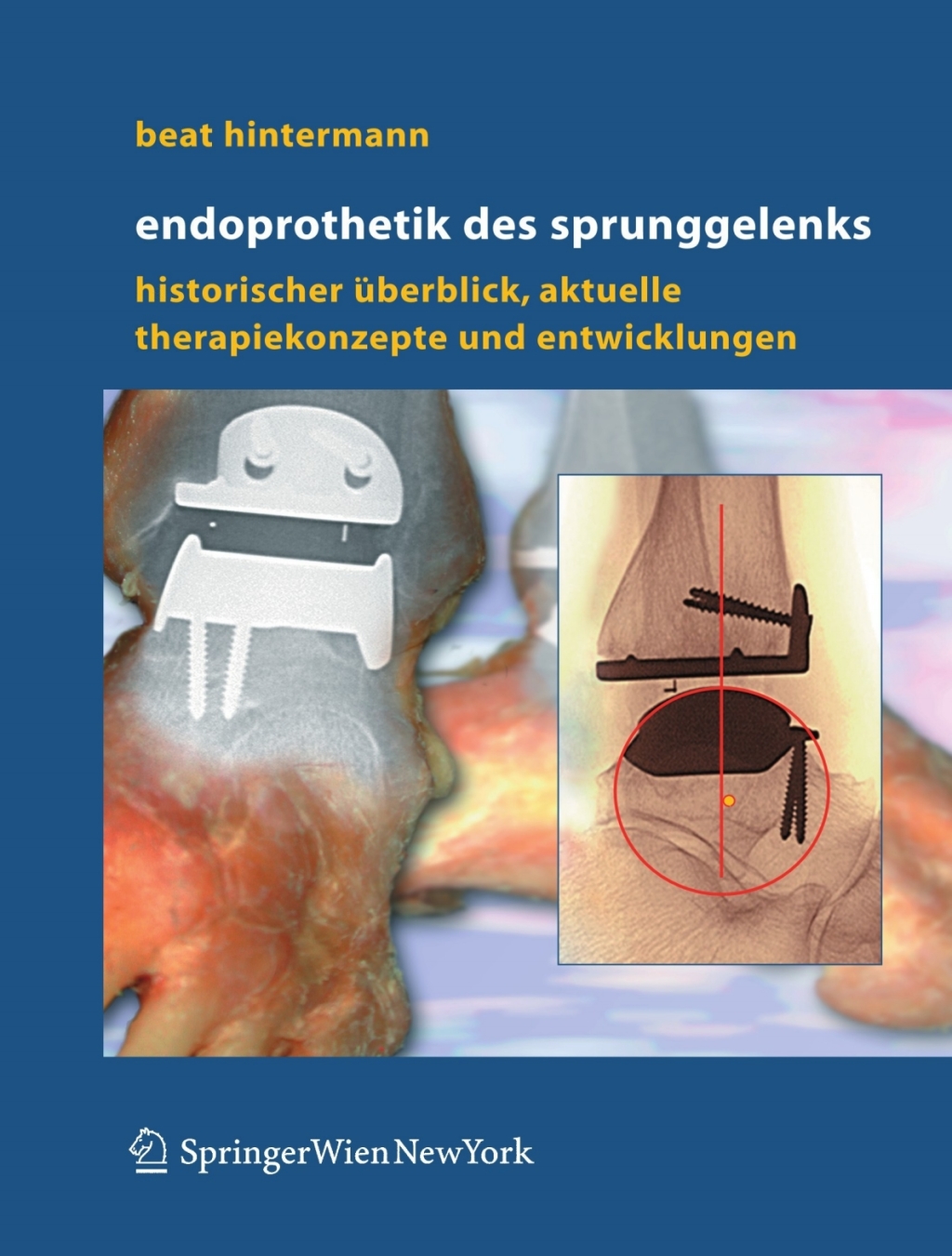 Endoprothetik des Sprunggelenks Historischer Überblick, aktuelle Therapiekonzepte und Entwicklungen