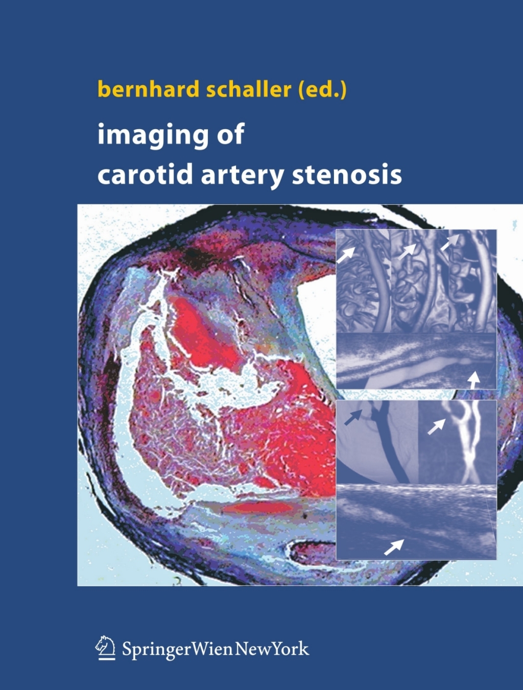 Imaging of Carotid Artery Stenosis 1st Edition