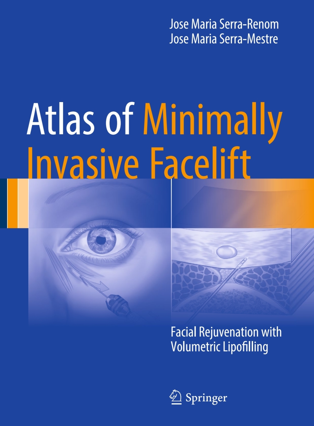Atlas of Minimally Invasive Facelift Facial Rejuvenation with Volumetric Lipofilling