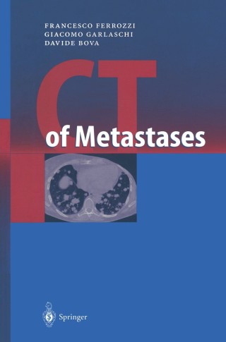 صورة الغلاف: CT of Metastases 9783540650973