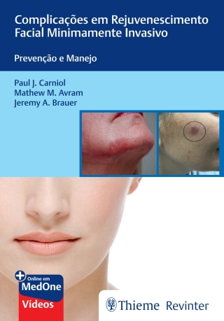 Cover image: Complicações em Rejuvenescimento Facial Minimamente Invasivo: Prevenção e Manejo 1st edition 9786555721232