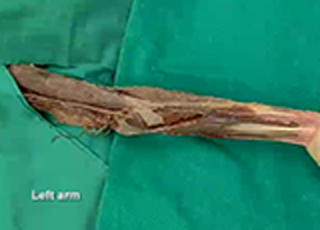 Imagen de portada: Upper Limb - Flexor Surface of the Forearm 1st edition 9788131258309