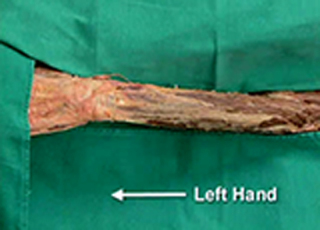 Cover image: Upper Limb - Extensor Surface of the Forearm and Dorsum of the Hand 1st edition 9788131258316