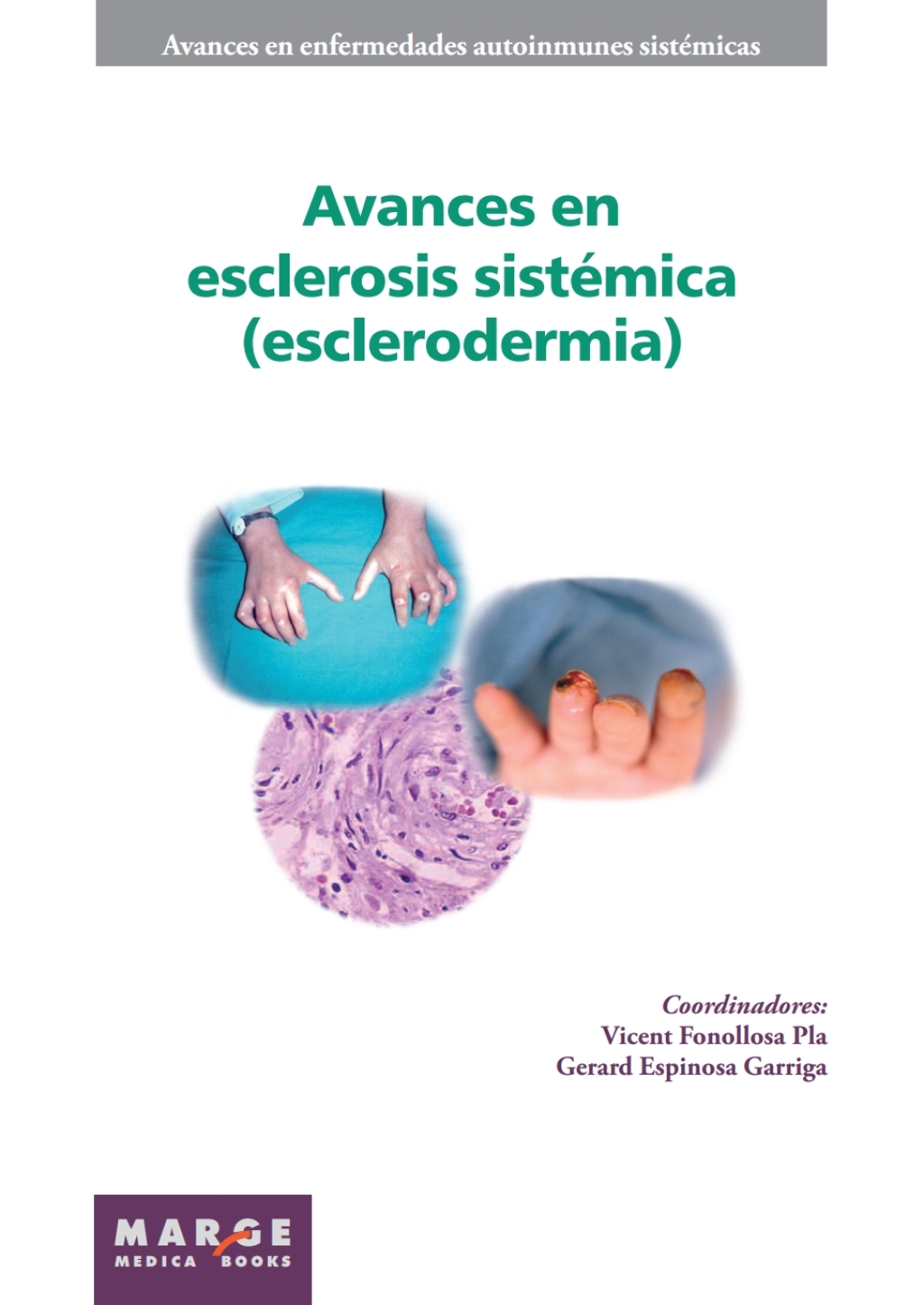 Avances en esclerosis sistémica (esclerodermia) 1st Edition