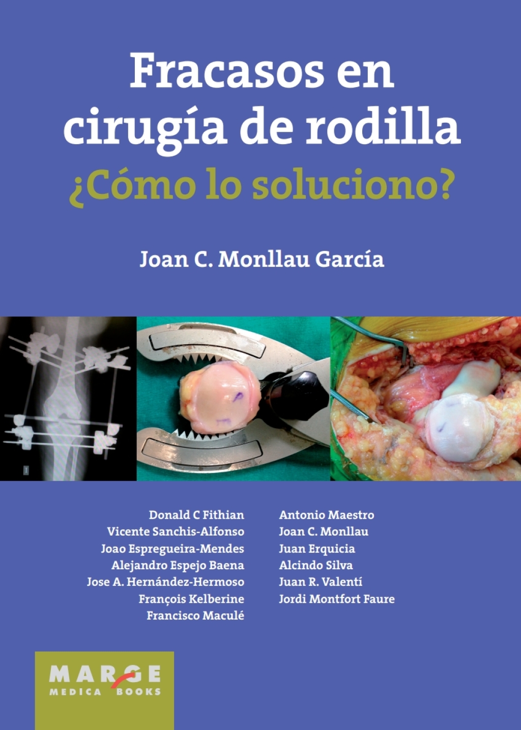 Fracasos en cirugía de rodilla 1st Edition