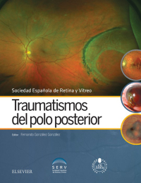 Cover image: Traumatismos del polo posterior 1st edition 9788491130529