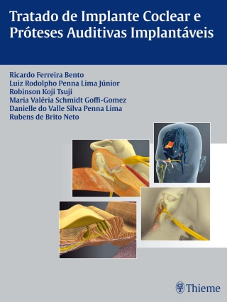 Cover image: Tratado de Implante Coclear e Próteses Auditivas Implantáveis 1st edition 9788567661025