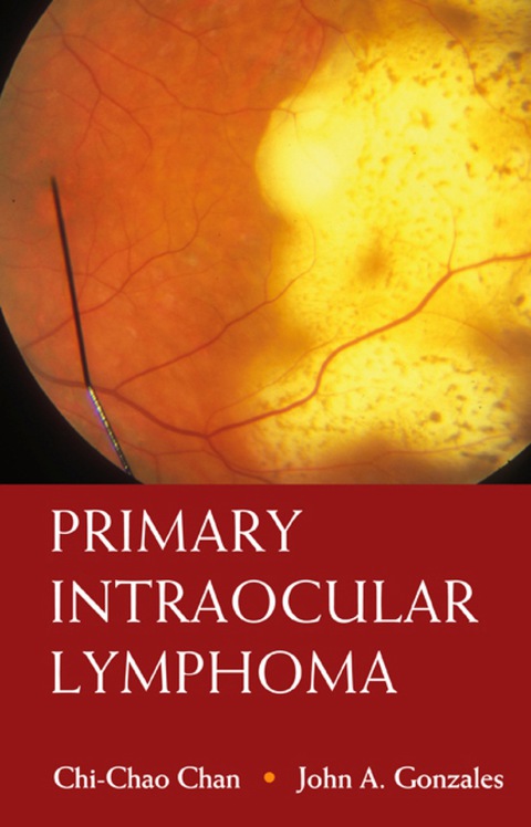 Primary Intraocular Lymphoma - FULL INSTANT DOWNLOAD | PDF DOCX EPUB