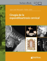 Imagen de portada: Cirugía de la espondiloartrosis cervical 1st edition 9789874922694