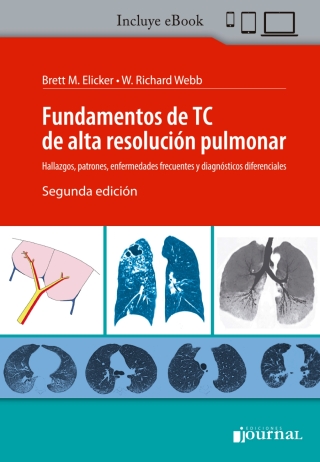 Cover image: Fundamentos de TC de alta resolución pulmonar 2nd edition 9789874922953